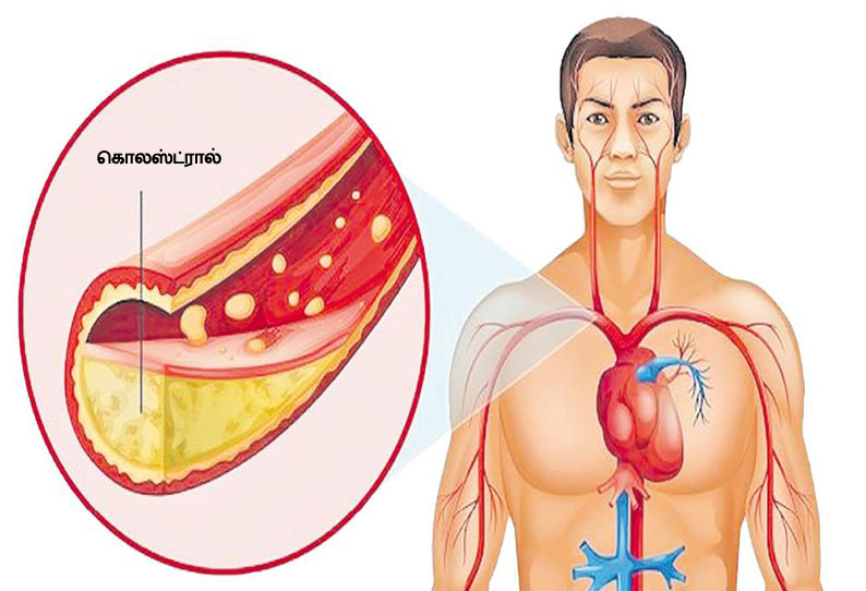 கொலஸ்ட்ரால்... பாதிப்புகளும், தப்பிக்கும் வழிகளும்