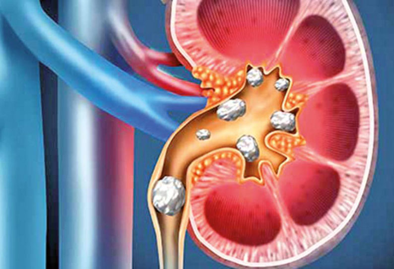 Daily one Information: Kidney Stones | தினம் ஒரு தகவல் : சிறுநீரக கற்கள்